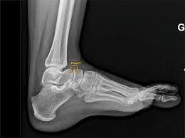 Bone Fracture Detection